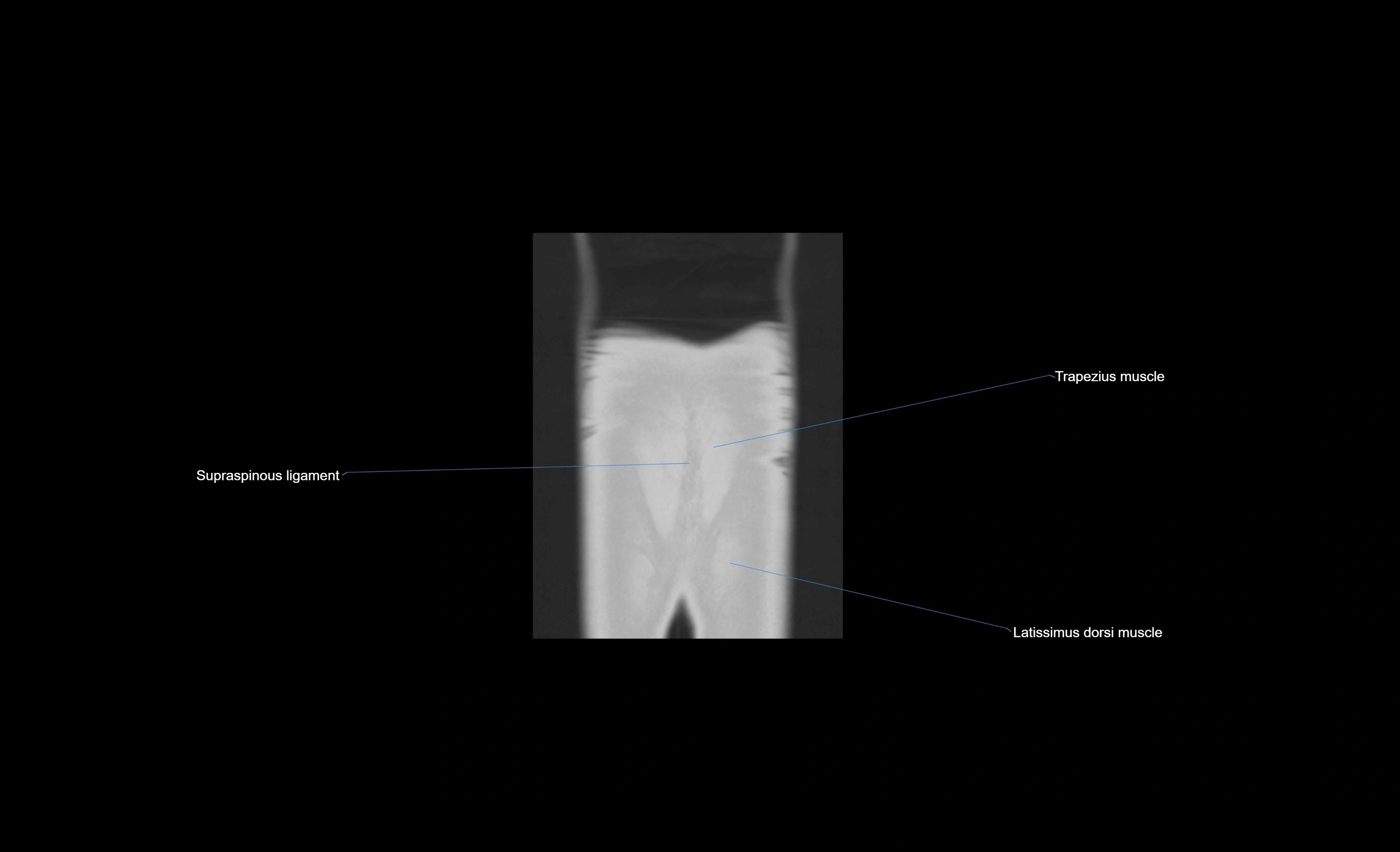 CT chest (thorax) lung window window labelled coronal cross sectional anatomy radiology image-00004.webp